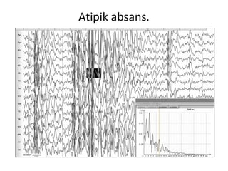Atipik absans.
 