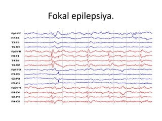 Fokal epilepsiya.
 