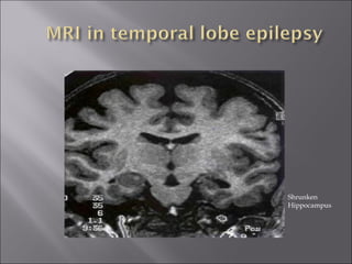 Shrunken Hippocampus 