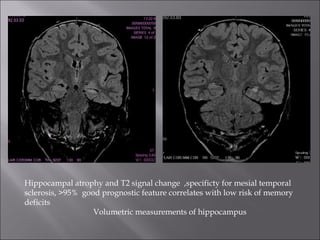 Hippocampal atrophy and T2 signal change  ,specificty for mesial temporal sclerosis, >95%  good prognostic feature correlates with low risk of memory deficits  Volumetric measurements of hippocampus 
