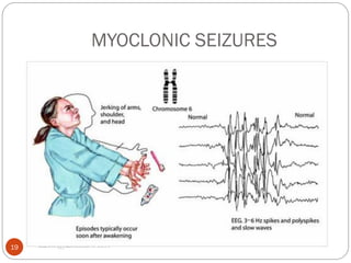 MYOCLONIC SEIZURES
asareor@yahoo.com © 2011
19
 