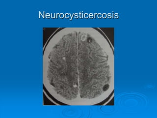 The causes of epilepsyGenetic factorCongenital abnormalitiesTrauma and the effect of craniotomyCNS infectionCerebrovascular diseaseCerebral tumorsAlzheimer’s disease and other degenerative disease Others