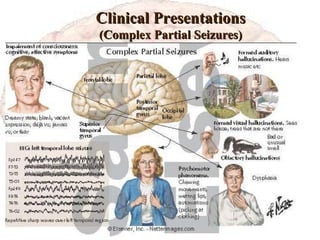 Clinical Presentations (Complex Partial Seizures) Definition: 
