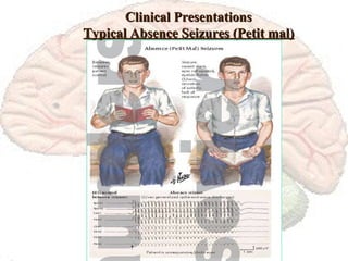 Clinical Presentations Typical Absence Seizures (Petit mal) 