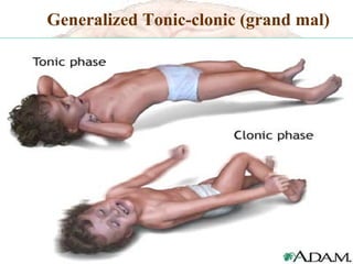 Generalized Tonic-clonic (grand mal) ,[object Object]