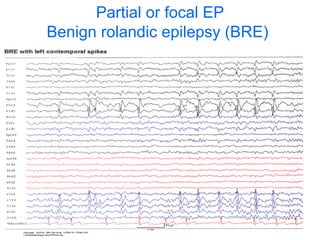 Partial or focal EP Benign rolandic epilepsy (BRE)   