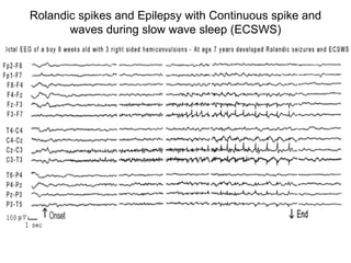Rolandic spikes and Epilepsy with Continuous spike and waves during slow wave sleep (ECSWS) 