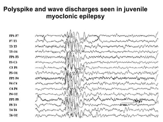 Polyspike and wave discharges seen in juvenile myoclonic epilepsy 