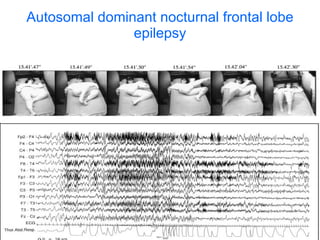 Autosomal dominant nocturnal frontal lobe epilepsy 