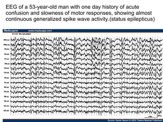 EEG of a 53-year-old man with one day history of acute confusion and slowness of motor responses, showing almost continuous generalized spike wave activity.(status epilepticus) 