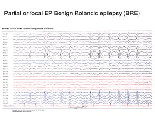 Partial or focal EP  Benign Rolandic epilepsy (BRE)   