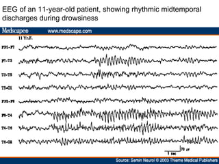 EEG of an 11-year-old patient, showing rhythmic midtemporal discharges during drowsiness  