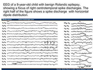 EEG of a 9-year-old child with benign Rolandic epilepsy, showing a focus of right centrotemporal spike discharges. The right half of the figure shows a spike discharge  with horizontal dipole distribution. 