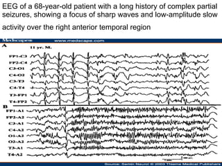 EEG of a 68-year-old patient with a long history of complex partial seizures, showing a focus of sharp waves and low-amplitude slow activity over the right anterior temporal region   