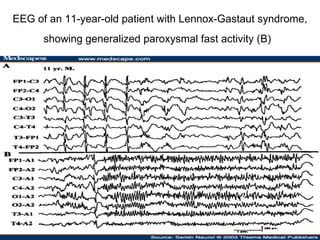 EEG of an 11-year-old patient with Lennox-Gastaut syndrome, showing generalized paroxysmal fast activity (B)   