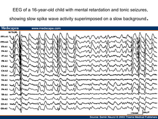 EEG of a 16-year-old child with mental retardation and tonic seizures, showing slow spike wave activity superimposed on a slow background .  