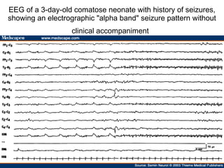 EEG of a 3-day-old comatose neonate with history of seizures, showing an electrographic "alpha band" seizure pattern without clinical accompaniment   
