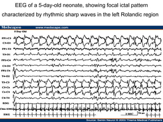 EEG of a 5-day-old neonate, showing focal ictal pattern characterized by rhythmic sharp waves in the left Rolandic region   