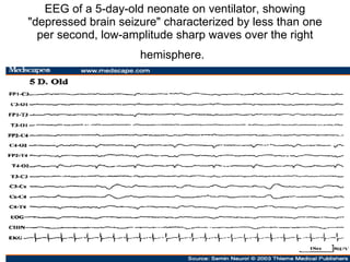 EEG of a 5-day-old neonate on ventilator, showing "depressed brain seizure" characterized by less than one per second, low-amplitude sharp waves over the right hemisphere.   