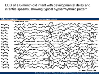 EEG of a 6-month-old infant with developmental delay and infantile spasms, showing typical hypsarrhythmic pattern  
