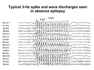 Typical 3-Hz spike and wave discharges seen in absence epilepsy 