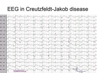 EEG in Creutzfeldt-Jakob disease  