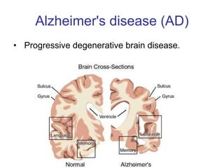 Alzheimer's disease (AD) Progressive degenerative brain disease.  