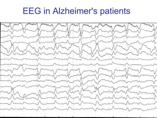 EEG in Alzheimer's patients 