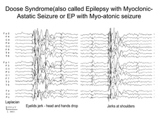 Doose Syndrome(also called Epilepsy with Myoclonic-Astatic Seizure or EP with Myo-atonic seizure 