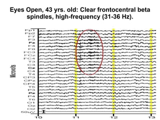 Eyes Open, 43 yrs. old: Clear frontocentral beta spindles, high-frequency (31-36 Hz). 