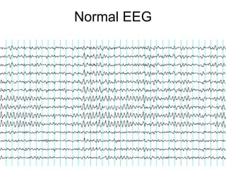 Normal EEG 