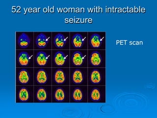 52 year old woman with intractable
seizure
PET scan
 
