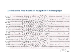 Absence seizure. The 3-Hz spike and wave pattern of absence epilepsy
 