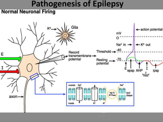 Pathogenesis of Epilepsy
 