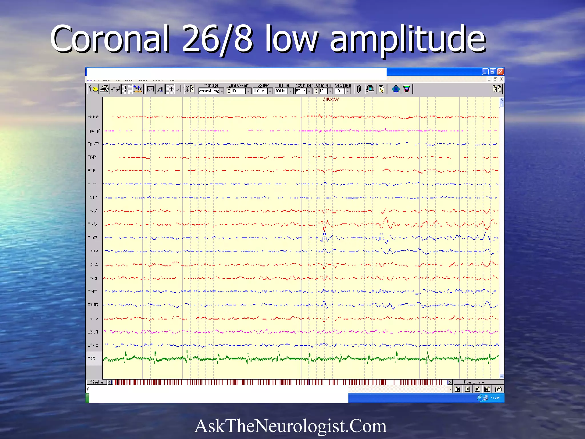 Coronal 26/8 low amplitude 