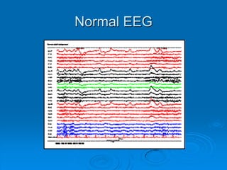  Detection of the structural brain lesion.EEG30 minute interictal EEG –useful when clinical suspicion of epilepsyTiming is importantWithin 24 hr of generalized convulsion: 50% have abnormal EEG First 48 hr: 21-34% have epileptiform activitySleep EEG or sleep-deprived EEG might increase diagnostic yield