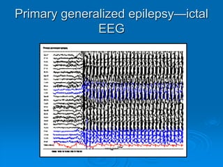Normal EEG