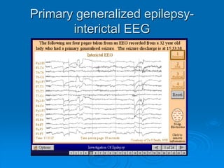 Primary generalized epilepsy—ictal EEG