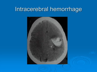 Cerebral infarction