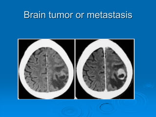 Intracerebral hemorrhage