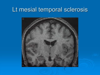 Brain tumor or metastasis