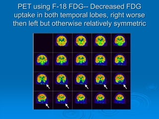 52 year old woman with intractable seizurePET scan