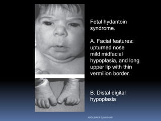 Fetal hydantoin
syndrome.
A. Facial features:
upturned nose
mild midfacial
hypoplasia, and long
upper lip with thin
vermilion border.
B. Distal digital
hypoplasia
ABOUBAKR ELNASHAR
 