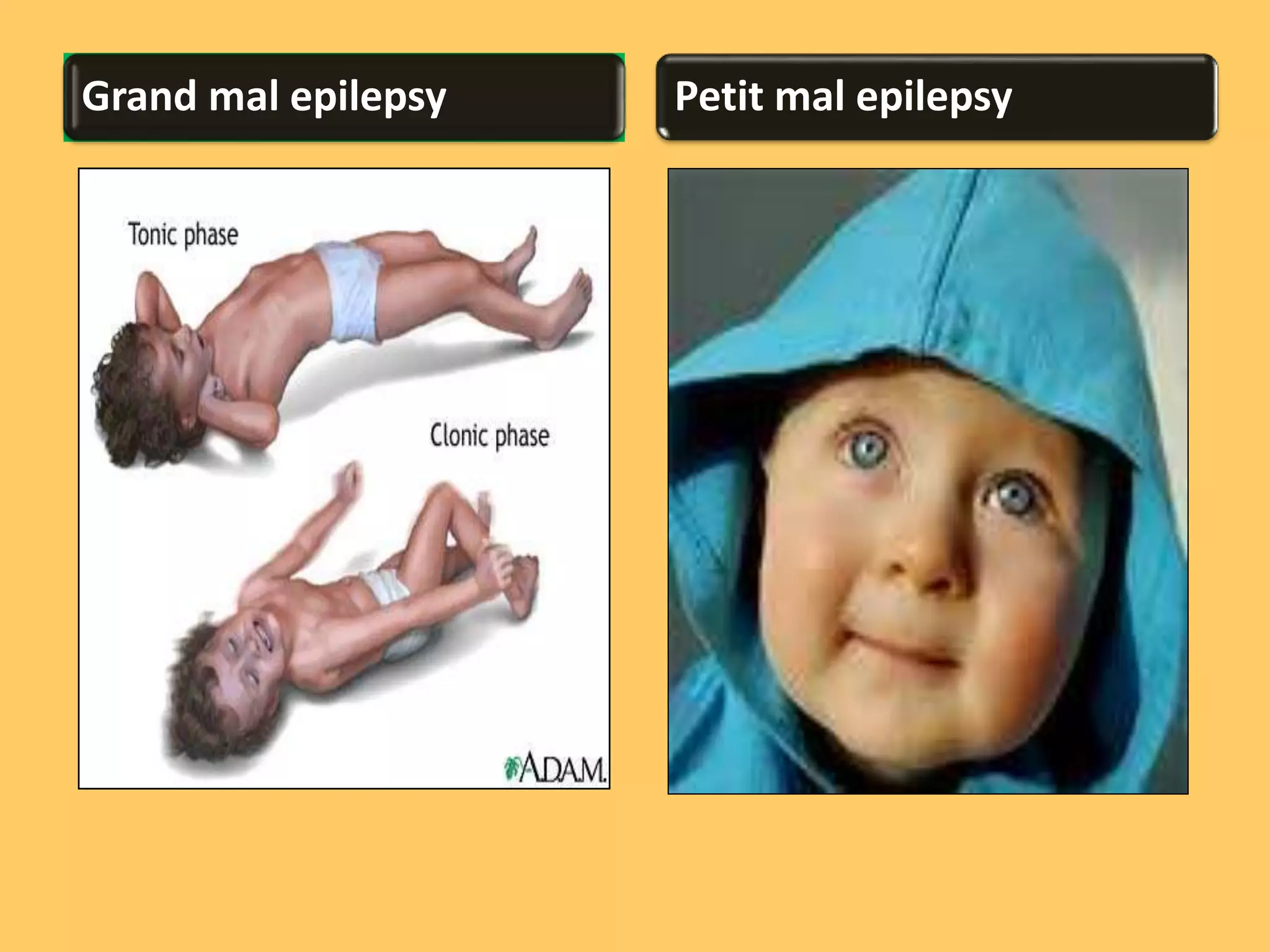 Epilepsy and its management (ppt) | PPTX