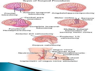 Epilepsy and management | PPTX