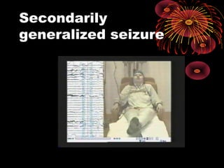 Secondarily
generalized seizure
 