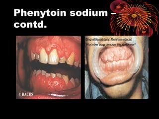 Phenytoin sodium –
contd.
 