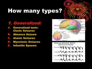 How many types?
1. Generalized:
A. Generalized tonic-
Clonic Seizures
B. Absence Seizure
C. Atonic Seizures
D. Myoclonic Seizures
E. Infantile Spasms
 