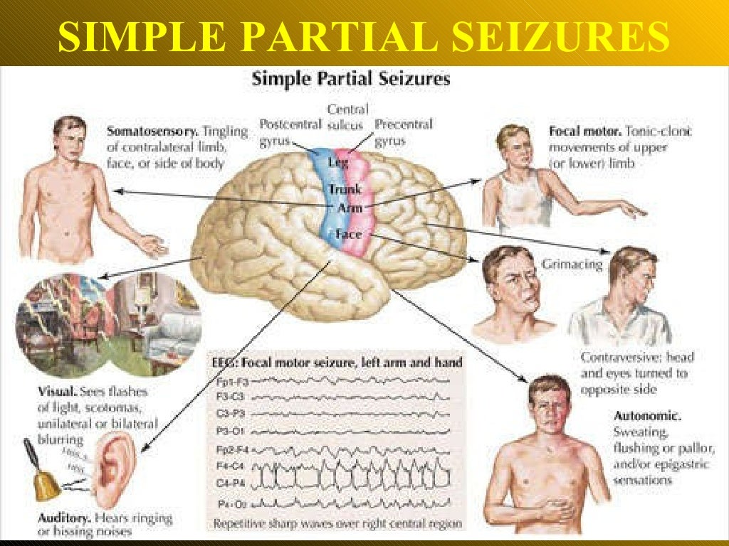 Epilepsy Ppt