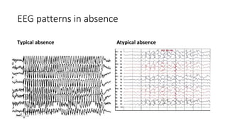 Epilepsy by hosam Maarouf Alhussin.. types | PPT